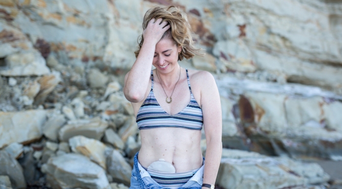 Q&A | Kate Montgomery: Crohn’s took my bowel, but have you seen my abs?